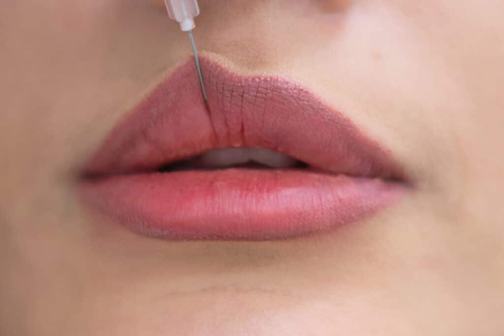 Liplifting avanguardia dell&rsquo;estetica per le labbra. Si tratta di una chirurgia sicura e innovativa che restituisce le proporzioni giovanili tra naso e labbra attraverso una piccola incisione sotto il naso e il riposizionamento dei tessuti sottostanti.