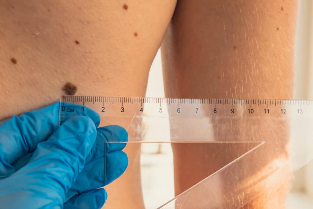 Mappatura dei nei È un esame microscopico di superficie. Durante la dermatoscopia, si utilizza uno strumento digitale attraverso il quale si ottiene un ingrandimento delle lesioni e senza alcuni riflessi della luce.