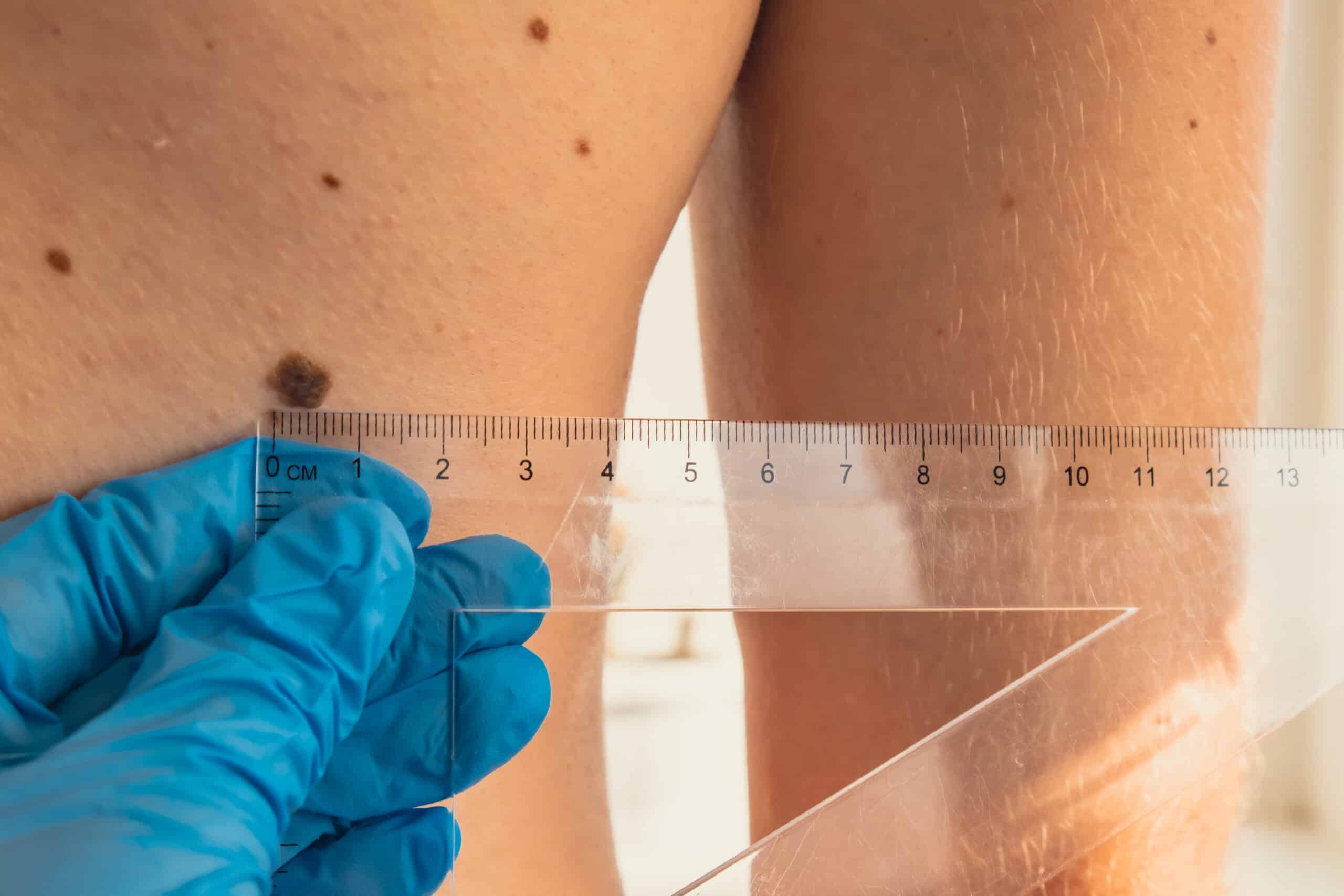 Mappatura dei nei È un esame microscopico di superficie. Durante la dermatoscopia, si utilizza uno strumento digitale attraverso il quale si ottiene un ingrandimento delle lesioni e senza alcuni riflessi della luce.